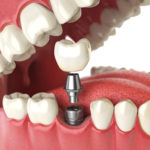 Dental Implant