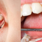 Dental Examination, Cavities
